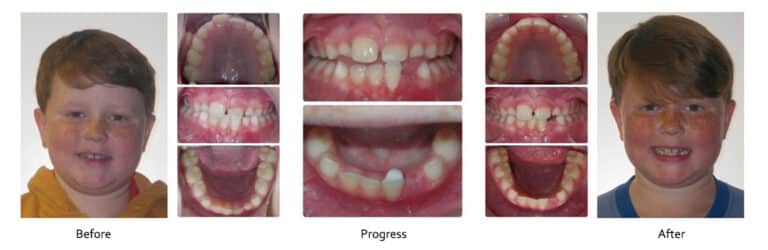 This patient came to us with an anterior (front) crossbite, which happens when teeth erupt out of place in such a way that an upper tooth becomes positioned behind a lower tooth. Front crossbites happen more commonly when the developing teeth are crowded, but can happen even without crowding.  In planning treatment, each case is different, but I always try to develop a treatment plan that is simple, non-invasive, rapid, and economical. For this patient, rather than use significant measures such as a Rapid Palatal Expander or Braces, we used a simple ramp made of tooth composite to help the upper tooth “jump” the lower tooth using the patient’s own biting force. After just 6 weeks and 2 appointments, the crossbite was gone, the composite was removed, and no retainer was needed!