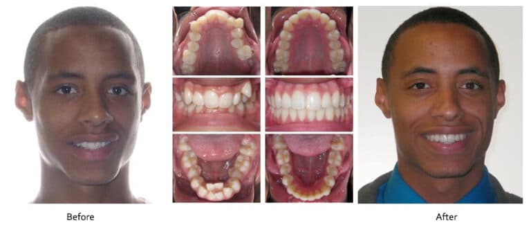 This patient presented with very narrow arches and severe crowding to the point that two of the patient’s lower teeth erupted behind the rest of the arch. Rather than doing extractions, we created room and lined up the teeth utilizing passive self-ligation system and techniques. We were able to expand the arches, align the teeth, and give this patient a nice broad smile with the Damon System – no extractions and no expanders. I believe that there is no amount of crowding that cannot be corrected without extracting teeth as long as doing so supports good facial balance. In other words, we extract for the face, not for the space. As a result, it is very rare that we recommend the extraction of permanent teeth.