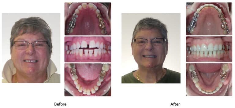 Although many seek orthodontic treatment to resolve crowded teeth, spacing can also be a concern. Besides being a significant esthetic problem, spacing can also lead to food impaction. In adults, we occasionally see spaces appearing where they did not exist before. This is often due to changes in the bone support of the teeth. Such was the case with the patient in this example. Once we verified that the teeth and gums were healthy and stable, we utilized passive, low-force mechanics with Invisalign , to successfully close her spaces. For patients that prefer Invisalign rather than the Damon System, I manage the Invisalign treatment mechanics to emulate the forces of the Damon system as much as possible. Doing so ensures that we can treat cases with braces or Invisalign with forces sufficiently light to facilitate movement without negatively affecting the bone support.