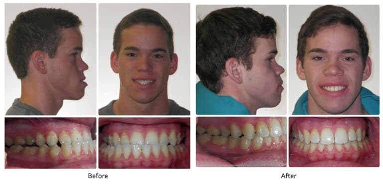 An underbite is when the lower teeth protrude in front of the upper teeth. This can be caused by tooth related problems or jaw related issues. For this patient, it was a jaw related problem. Even when bite problems are skeletal in nature, and would have traditionally required jaw surgery, we actively avoid surgery in as many cases as possible by camouflaging the skeletal problems. We often do this using the Damon System in combination with TAD's to either retract the lower arch and/or protrude the upper arch. However, if the skeletal problems are to the extent that camouflage is not possible then orthognathic surgery is the most appropriate solution. This patient was treated with Invisalign followed by surgery on both jaws.